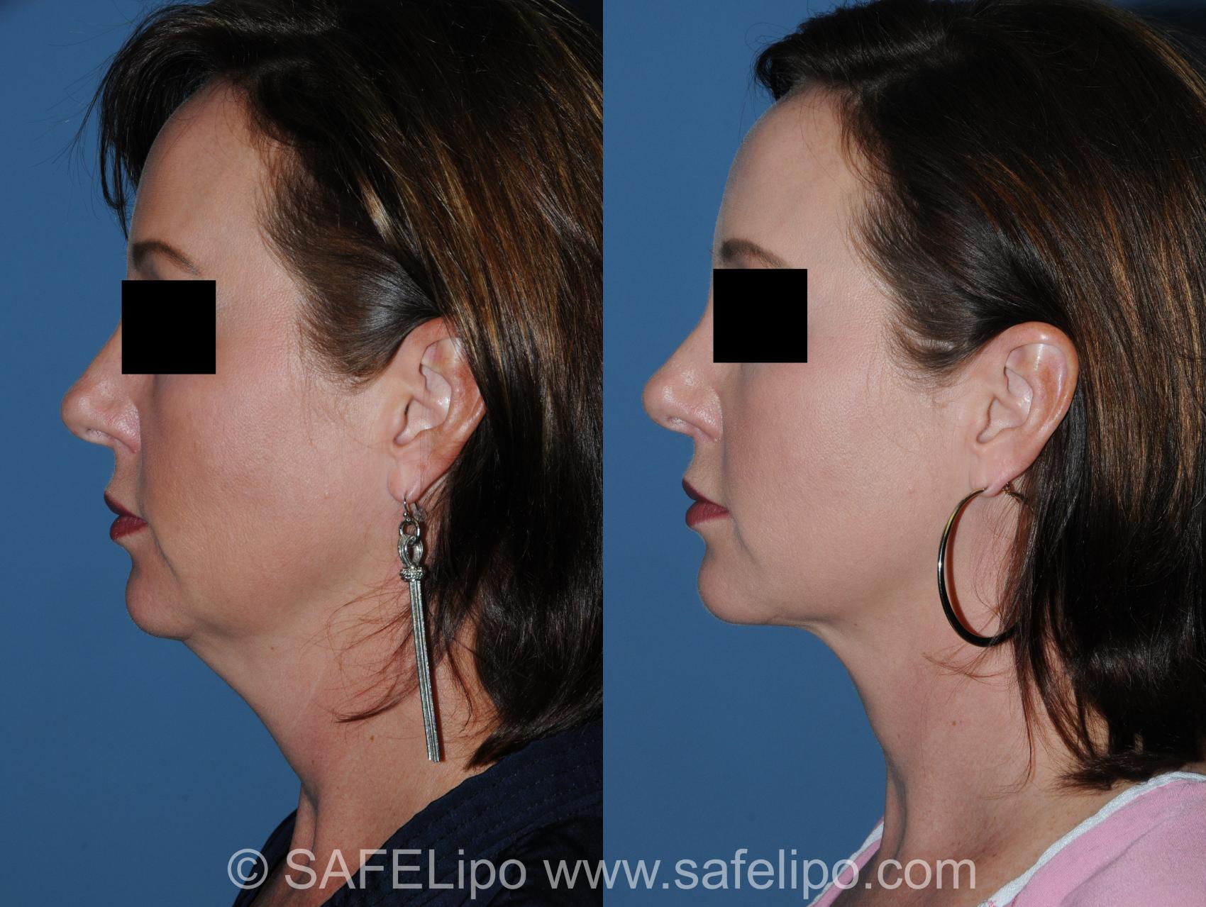 Submental SAFELipo Left Side Photo, Shreveport, LA, The Wall Center for Plastic Surgery, Case 348