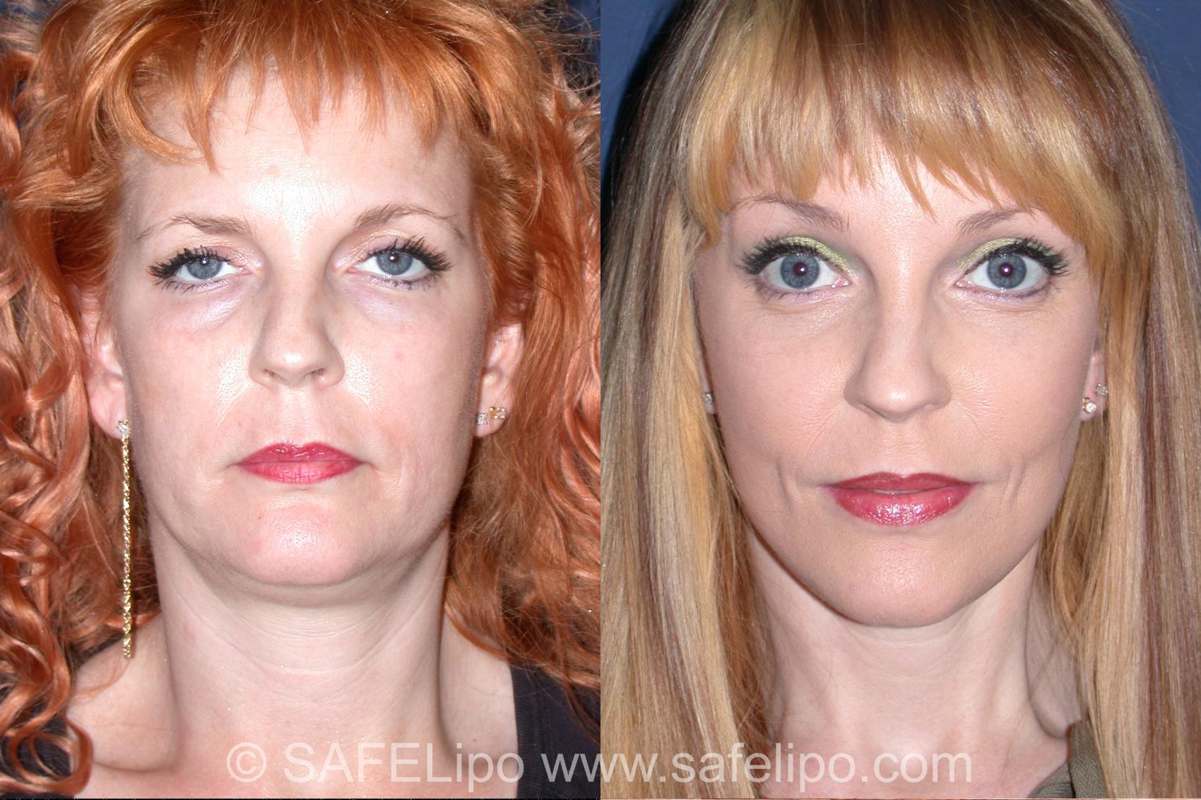 Face Lift Front Photo, Shreveport, Louisiana, The Wall Center for Plastic Surgery, Case 352