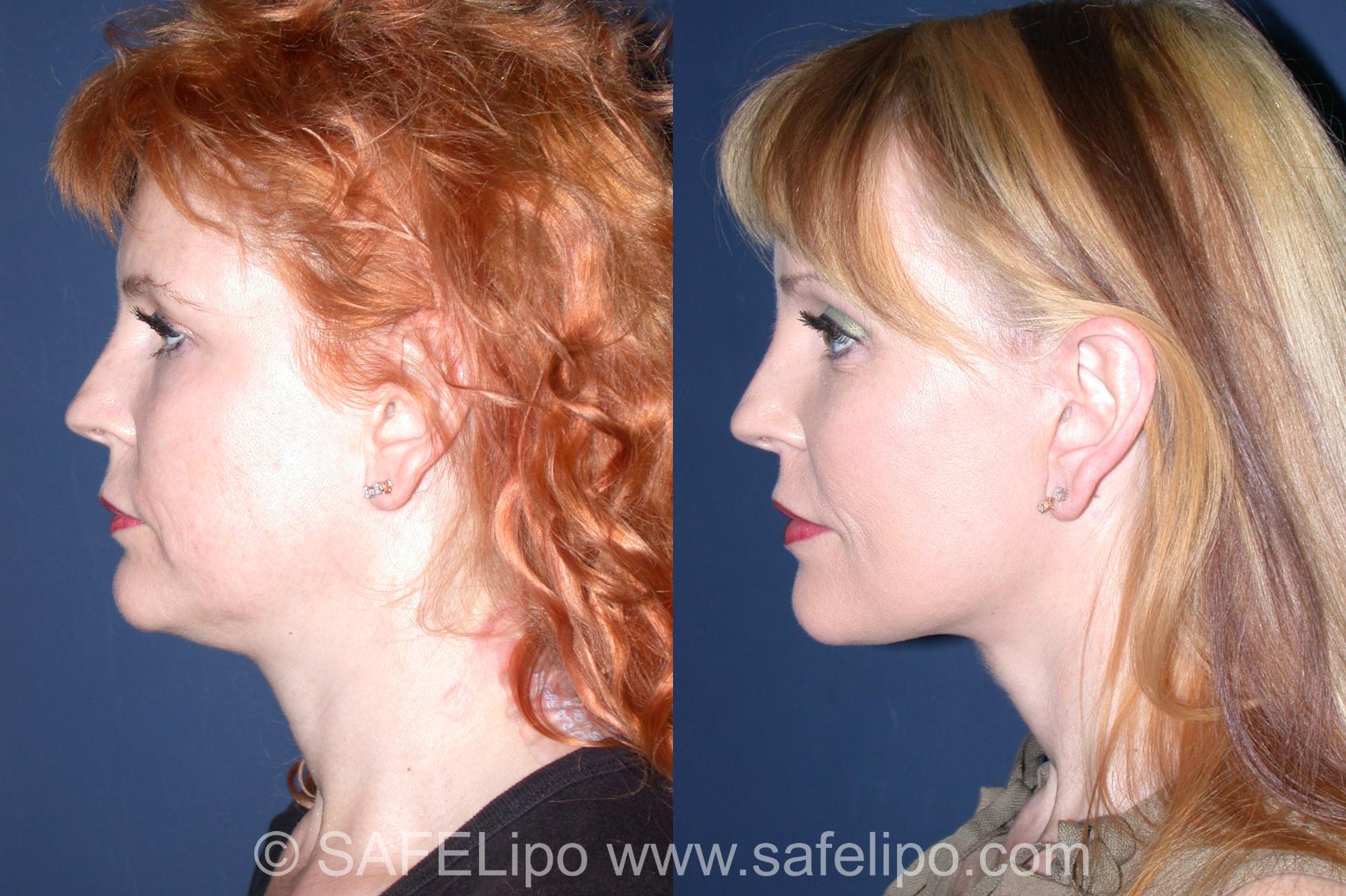 Face Lift Front Photo, Shreveport, Louisiana, The Wall Center for Plastic Surgery, Case 352