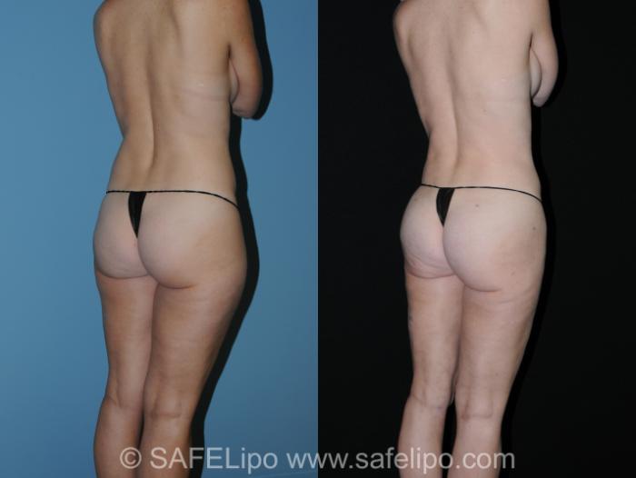 SAFELipo Back Right Oblique Photo, Shreveport, LA, The Wall Center for Plastic Surgery, Case 260