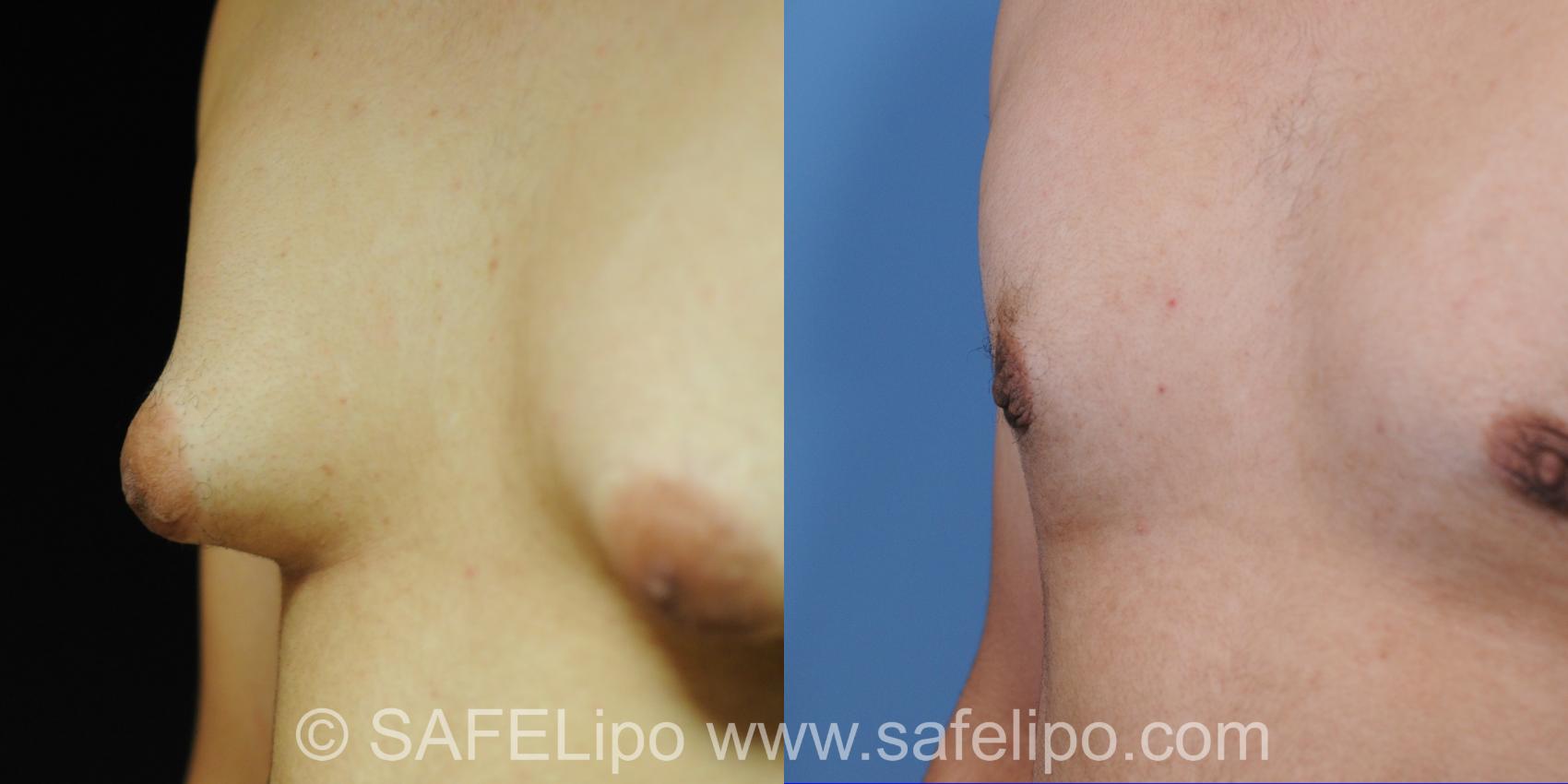 Gynecomastia Right Nipple Photo, Shreveport, LA, The Wall Center for Plastic Surgery, Case 252