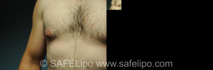 Gynecomastia Right Nipple Photo, Shreveport, LA, The Wall Center for Plastic Surgery, Case 255