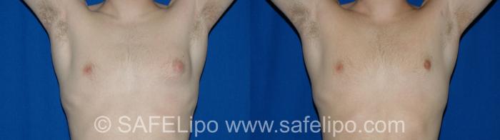 Gynecomastia Front Arms Raised Photo, Shreveport, LA, The Wall Center for Plastic Surgery, Case 258