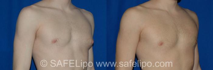 Gynecomastia Right Oblique Photo, Shreveport, LA, The Wall Center for Plastic Surgery, Case 258