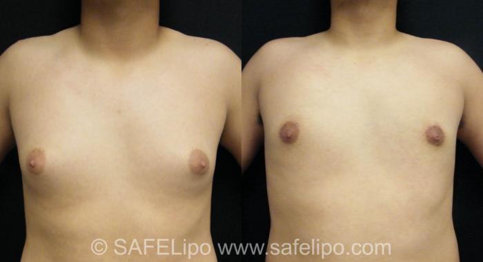 Male Breast Reduction Case 393 Before & After View #1 | SAFELipo®