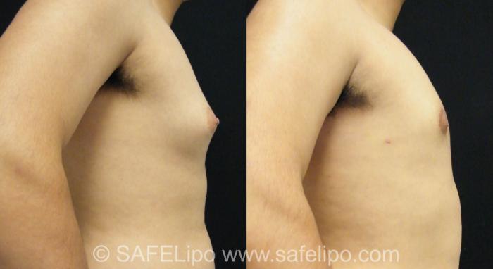 Male Breast Reduction Case 393 Before & After View #2 | SAFELipo®