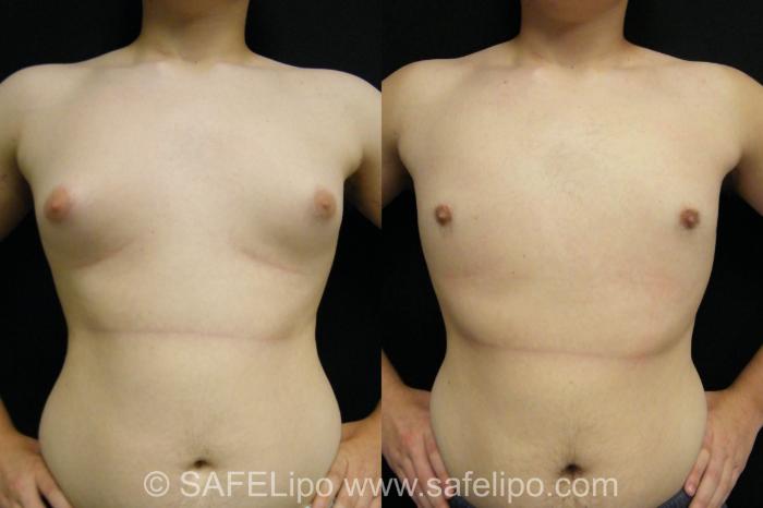 Male Breast Reduction Case 395 Before & After View #1 | SAFELipo®