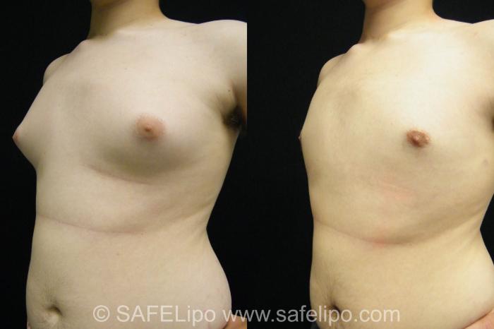 Male Breast Reduction Case 395 Before & After View #2 | SAFELipo®