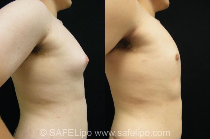 Male Breast Reduction Case 395 Before & After View #3 | SAFELipo®
