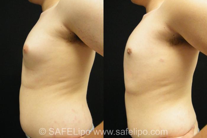 SAFELipoHD® Case 395 Before & After View #4 | SAFELipo®