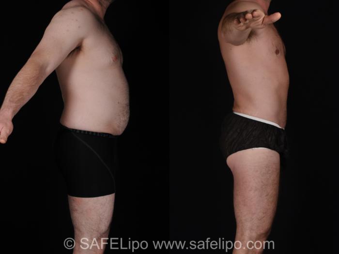 Abdominoplasty Right Side Photo, Shreveport, LA, The Wall Center for Plastic Surgery, Case 566