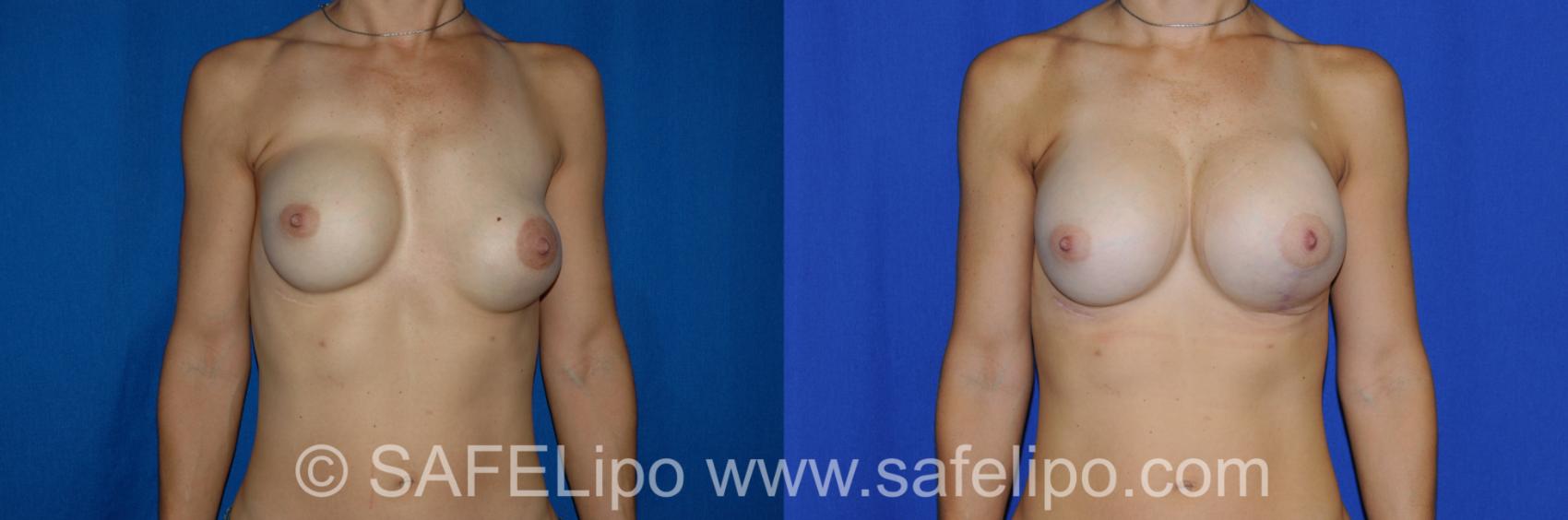 Implant Exchange Front Photo, Shreveport, Louisiana, The Wall Center for Plastic Surgery, Case 274