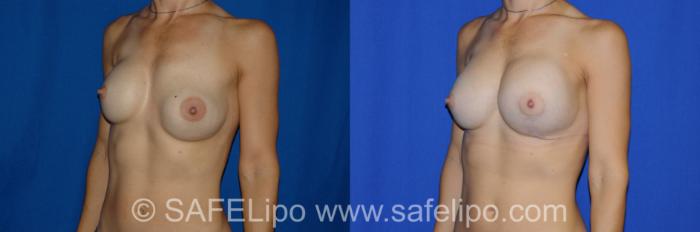 Implant Exchange Left Oblique Photo, Shreveport, LA, The Wall Center for Plastic Surgery, Case 274