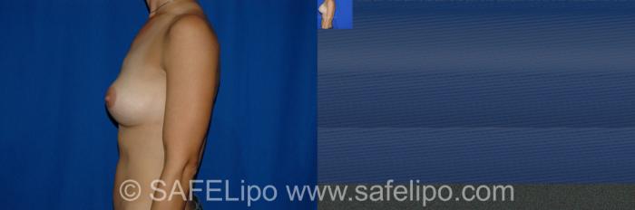 Implant Exchange Left Side Photo, Shreveport, LA, The Wall Center for Plastic Surgery, Case 274