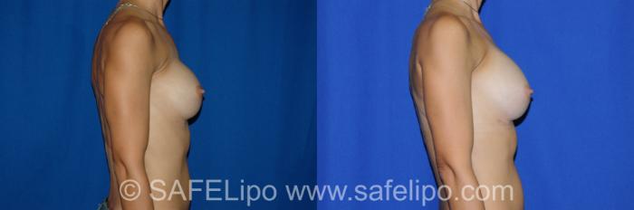 Implant Exchange Right Side Photo, Shreveport, LA, The Wall Center for Plastic Surgery, Case 274