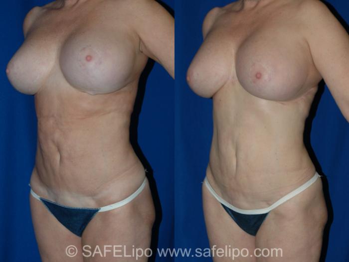 SAFELipo Left Oblique Photo, Shreveport, Louisiana, The Wall Center for Plastic Surgery, Case 338