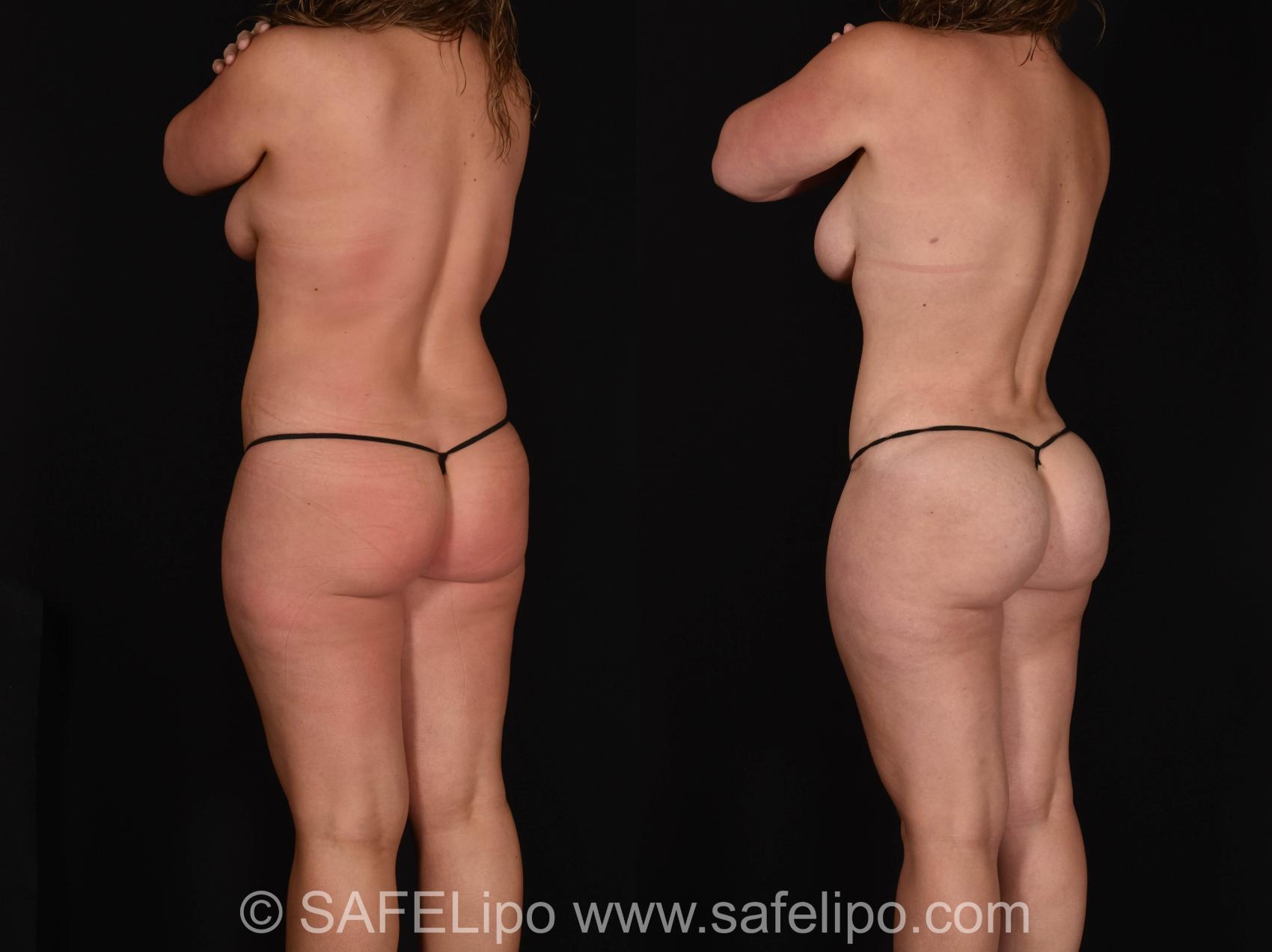 SAFELipo Back Left Oblique Photo, Shreveport, LA, The Wall Center for Plastic Surgery, Case 1009