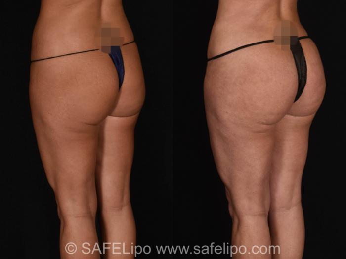 BBA SAFELipo Back Left Oblique Photo, Shreveport, LA, The Wall Center for Plastic Surgery, Case 1011