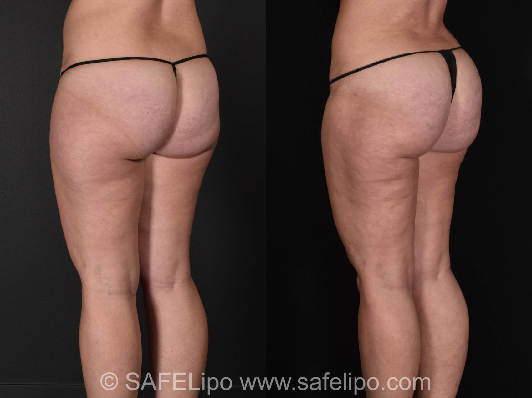 SAFELipo® SSBA for Butt Lifting Case 1013 Before & After Back Left Oblique | SAFELipo®