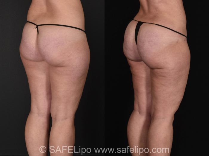Fat Grafting – Buttocks Case 1013 Before & After Back Right Oblique | SAFELipo®