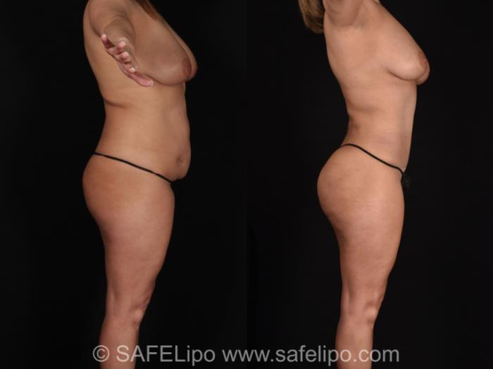 Abdominoplasty Right Side Photo, Shreveport, LA, The Wall Center for Plastic Surgery, Case 1019