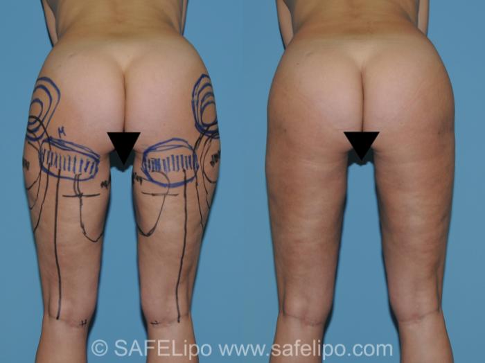 SAFELipo Back Bent Over Photo, Shreveport, Louisiana, The Wall Center for Plastic Surgery, Case 272