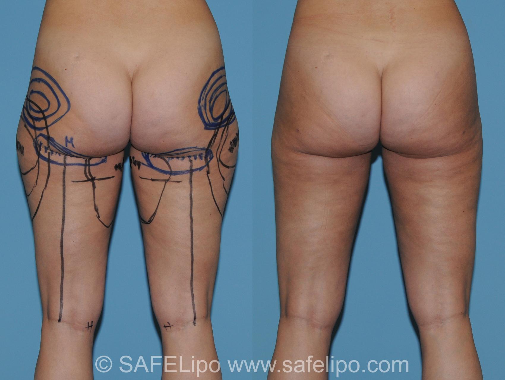 SAFELipo Back Photo, Shreveport, Louisiana, The Wall Center for Plastic Surgery, Case 272