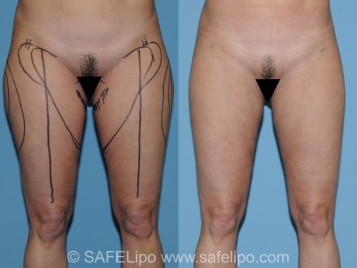 SAFELipo Left Oblique Photo, Shreveport, Louisiana, The Wall Center for Plastic Surgery, Case 272