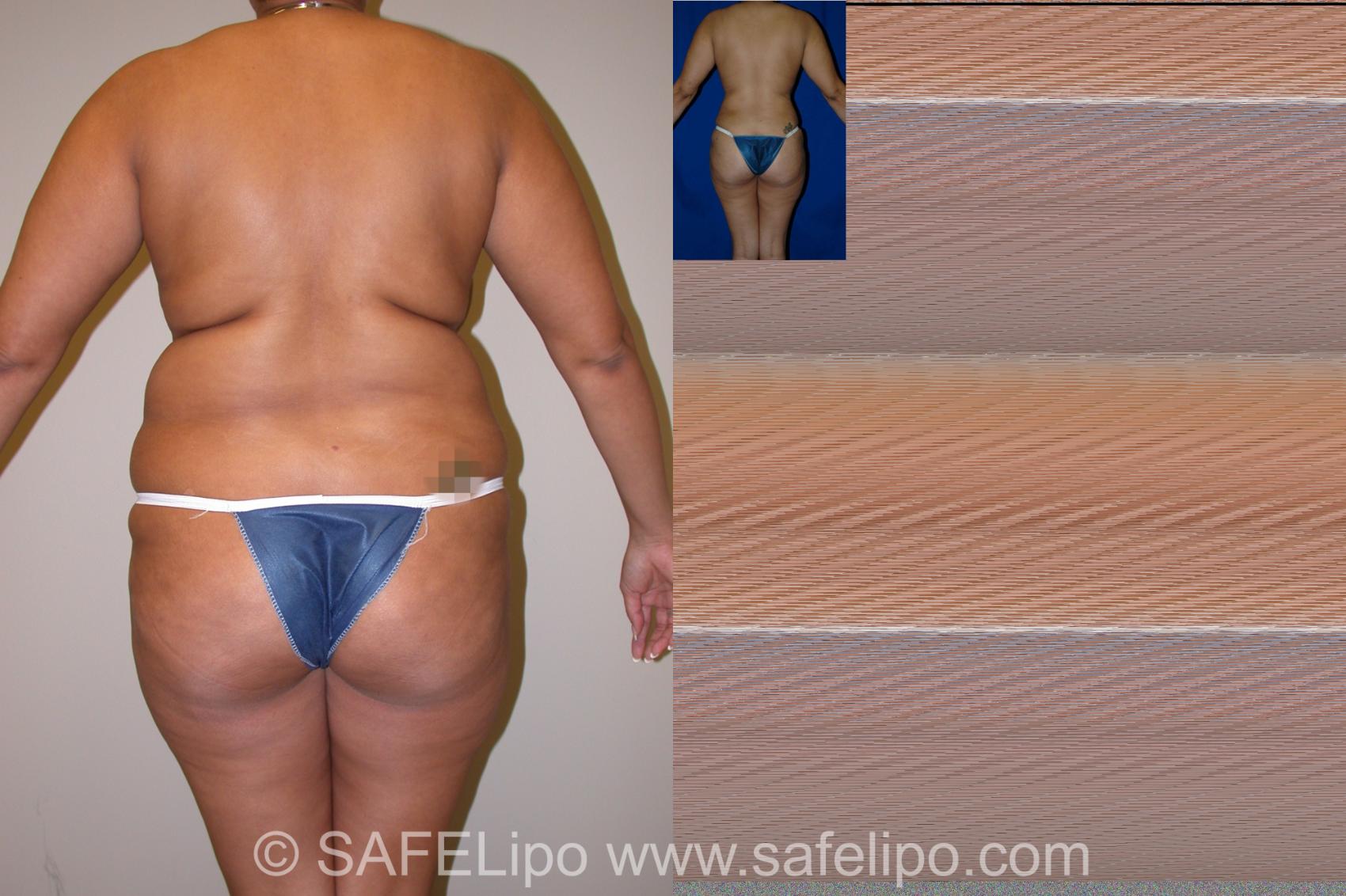 SAFELipo Back Photo, Shreveport, Louisiana, The Wall Center for Plastic Surgery, Case 1