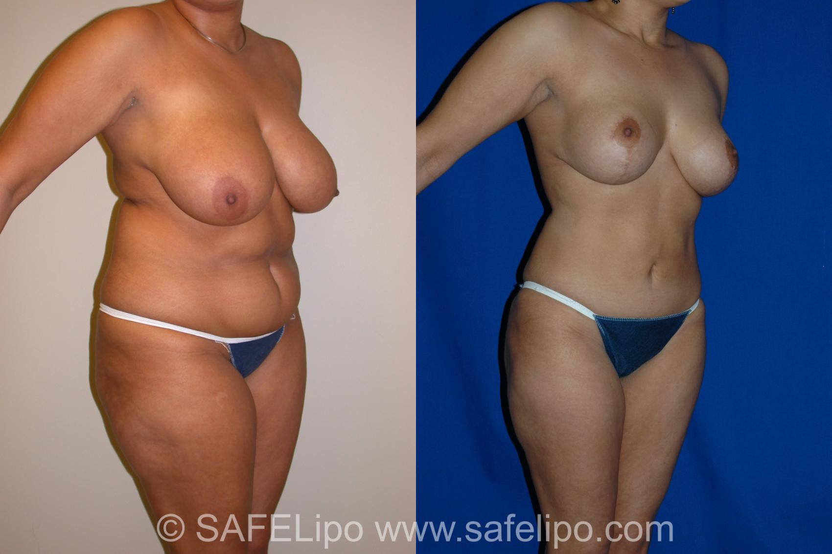 SAFELipo Right Oblique Photo, Shreveport, Louisiana, The Wall Center for Plastic Surgery, Case 1