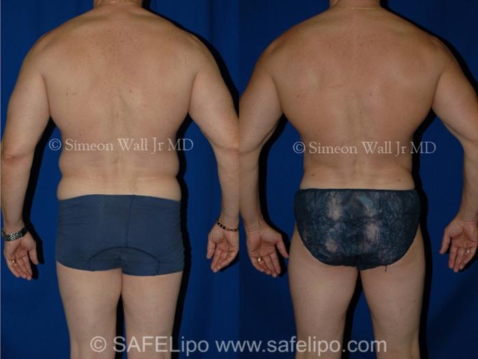 SAFELipoHD® Case 1001 Before & After Back | SAFELipo®