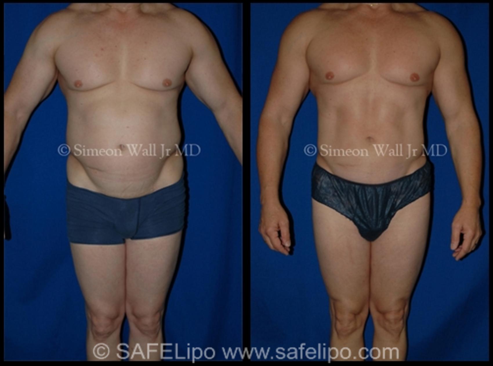 SAFELipo®360 Case 1001 Before & After Front | SAFELipo®