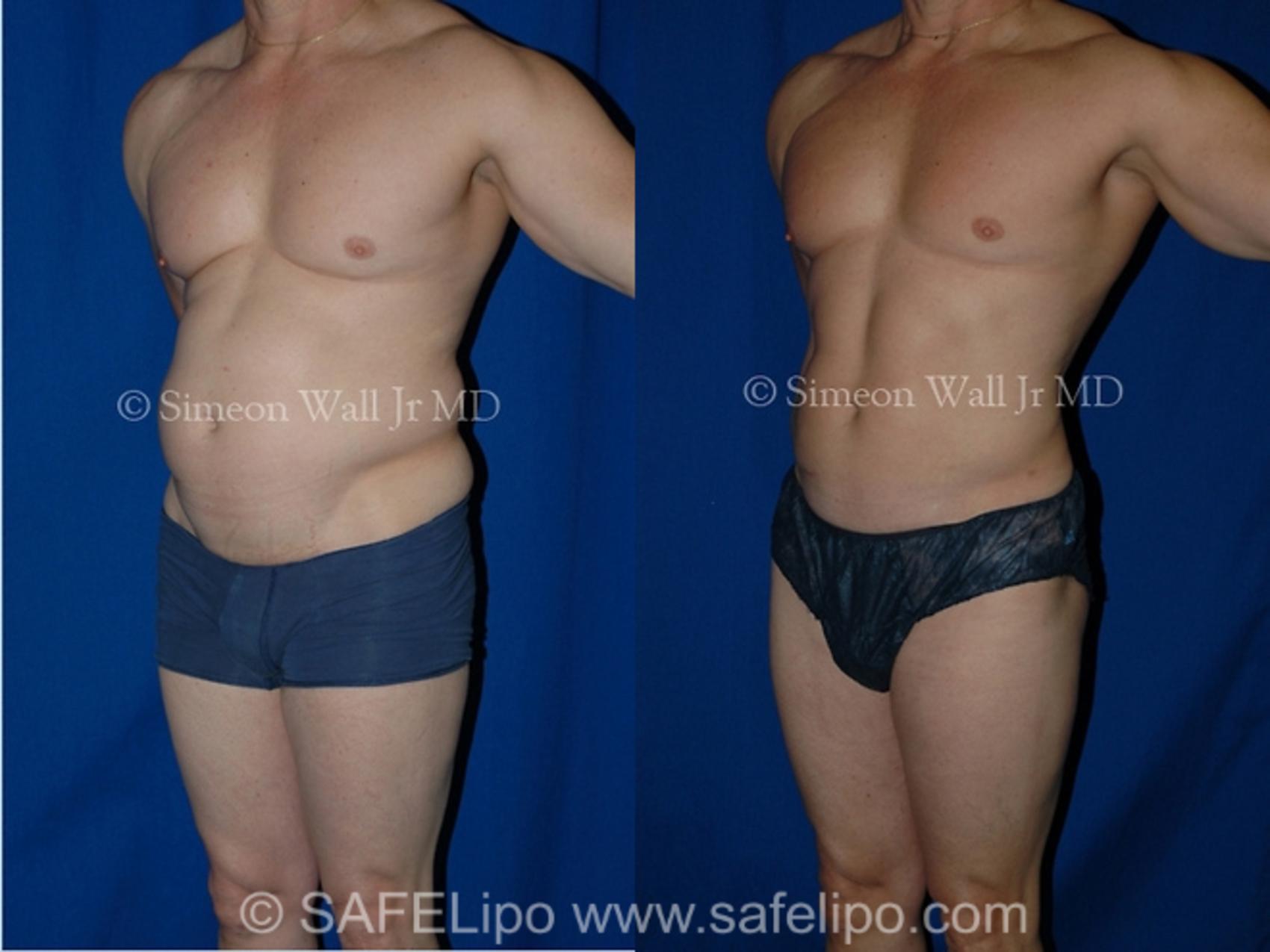 SAFELipo®360 Case 1001 Before & After Left Oblique | SAFELipo®