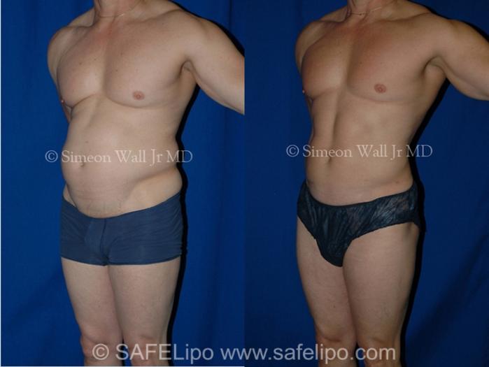 SAFELipoHD® Case 1001 Before & After Left Oblique | SAFELipo®