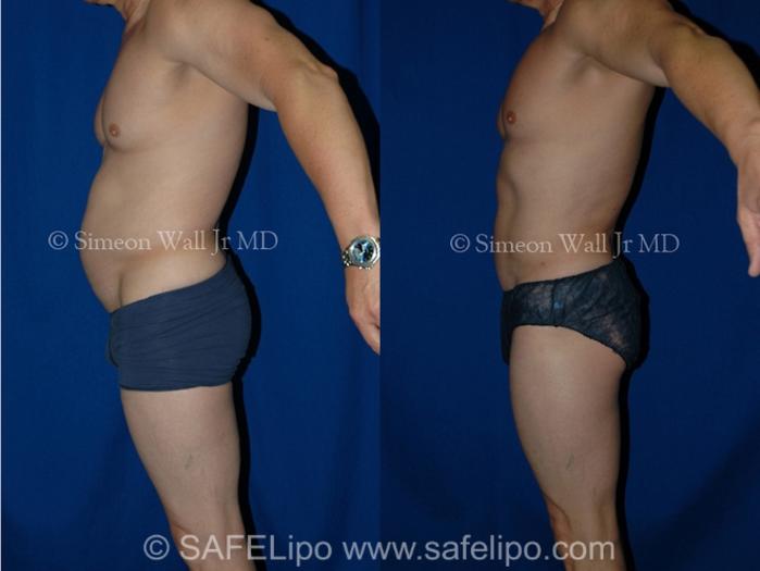 SAFELipoHD® Case 1001 Before & After Left Side | SAFELipo®