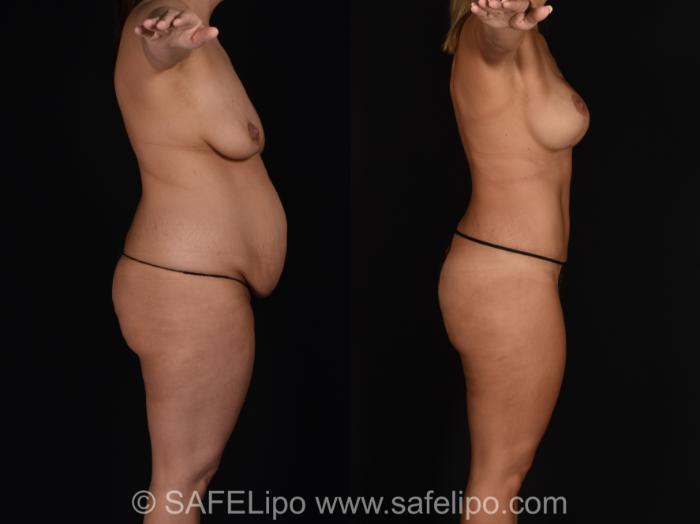 Abdominoplasty Right Side Photo, Shreveport, LA, The Wall Center for Plastic Surgery, Case 1018