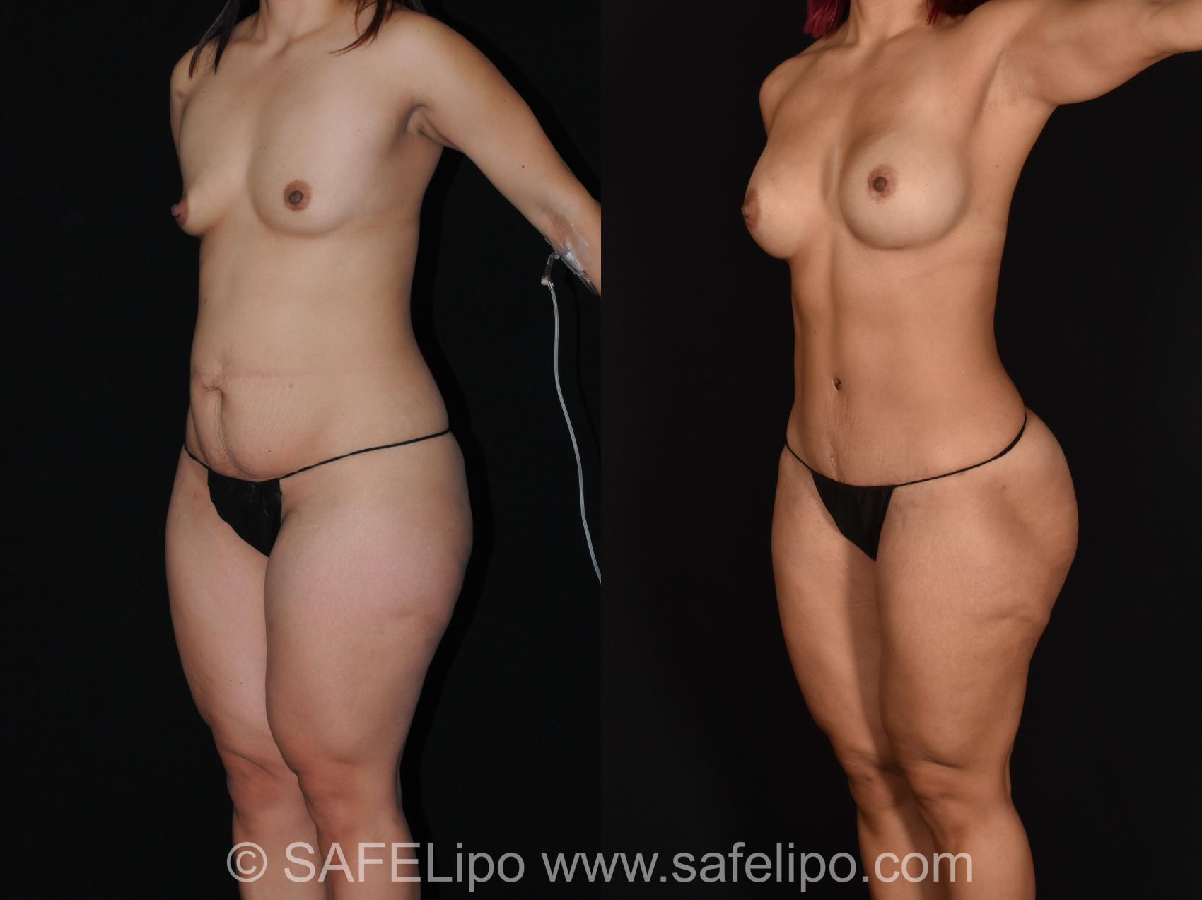 Abdominoplasty Left Oblique Photo, Shreveport, LA, The Wall Center for Plastic Surgery, Case 1020