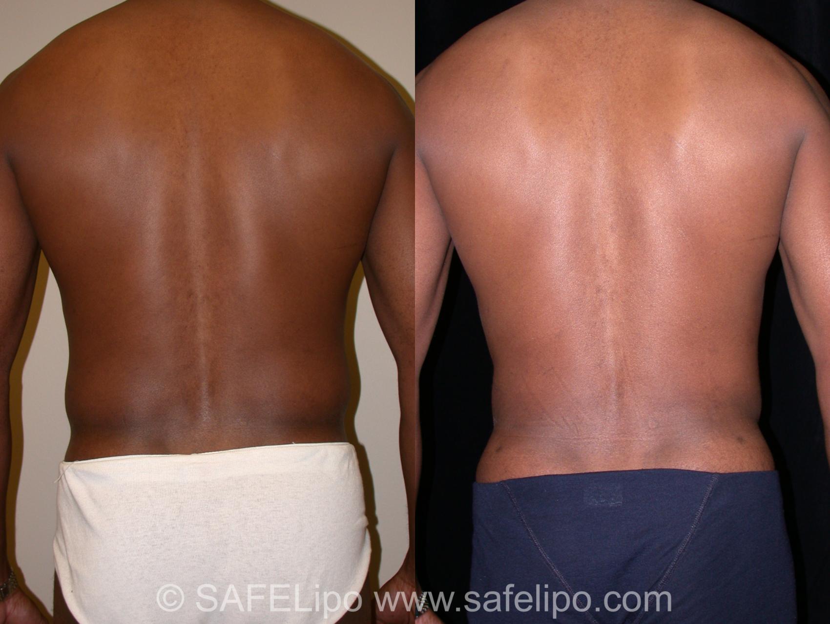 SAFELipo Back Photo, Shreveport, Louisiana, The Wall Center for Plastic Surgery, Case 13