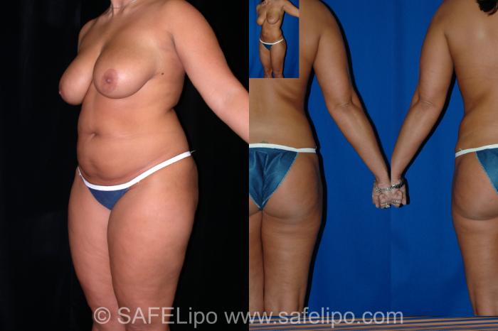SAFELipo Left Oblique Photo, Shreveport, Louisiana, The Wall Center for Plastic Surgery, Case 2