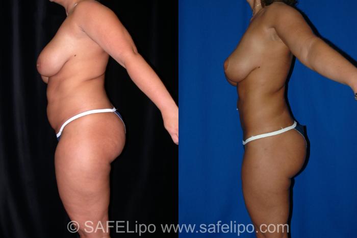 SAFELipo Left Side Photo, Shreveport, Louisiana, The Wall Center for Plastic Surgery, Case 2