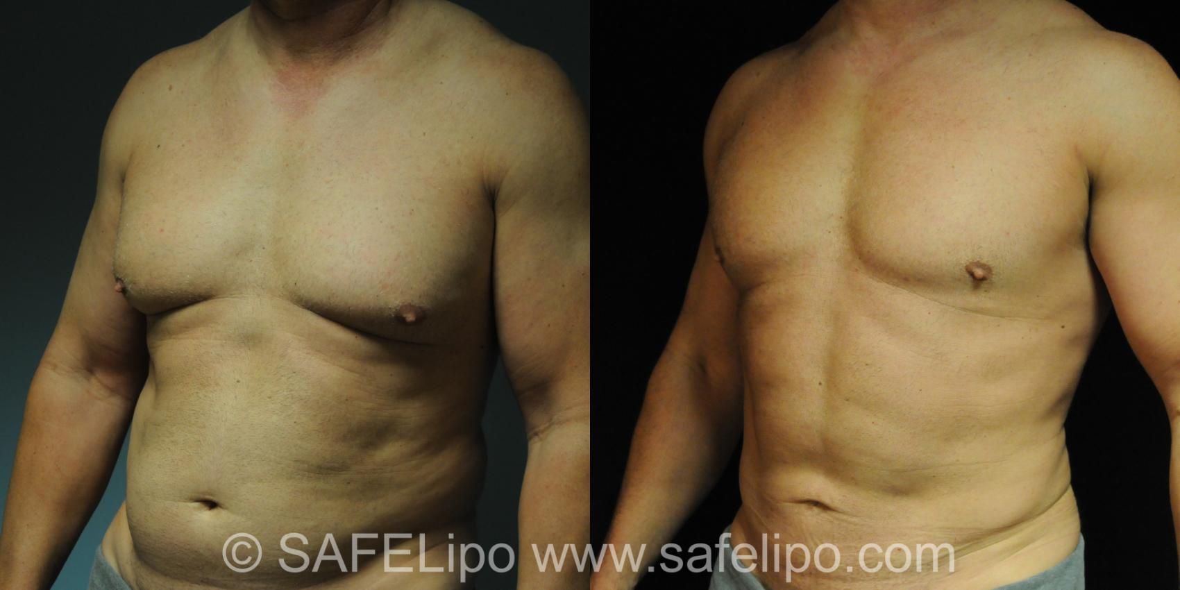 SAFELipo Front Photo, Shreveport, Louisiana, The Wall Center for Plastic Surgery, Case 212