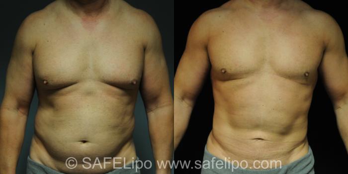 Male Breast Reduction Case 212 Before & After View #1 | SAFELipo®