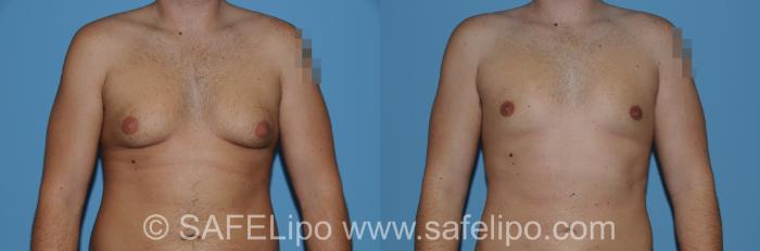 SAFELipo Front Chest Photo, Shreveport, Louisiana, The Wall Center for Plastic Surgery, Case 259