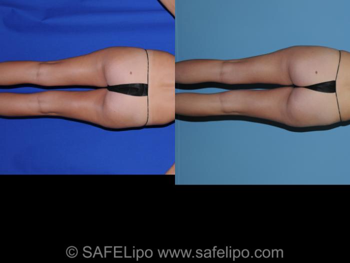 SAFELipoHD® Case 266 Before & After View #4 | SAFELipo®