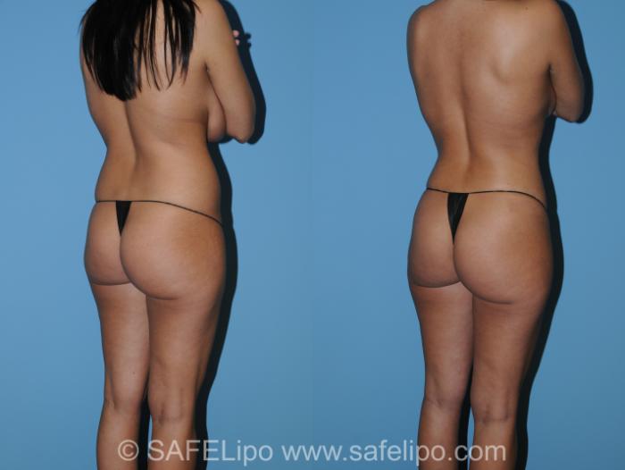 SAFELipo Back Right Oblique Photo, Shreveport, LA, The Wall Center for Plastic Surgery, Case 267