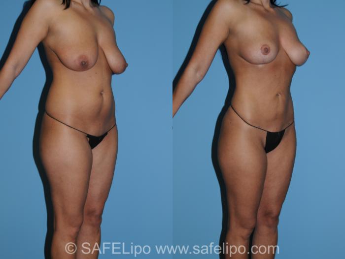 SAFELipo Right Oblique Photo, Shreveport, LA, The Wall Center for Plastic Surgery, Case 267