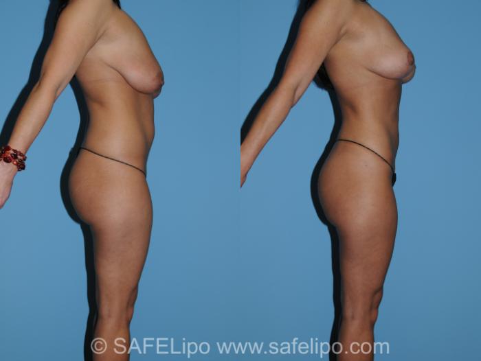 SAFELipo Right Side Photo, Shreveport, Louisiana, The Wall Center for Plastic Surgery, Case 267