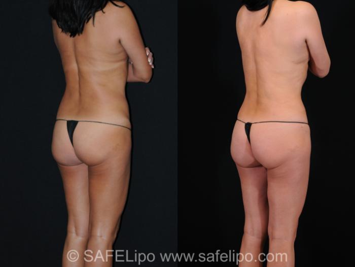 SAFELipo Back Right Oblique Photo, Shreveport, LA, The Wall Center for Plastic Surgery, Case 268