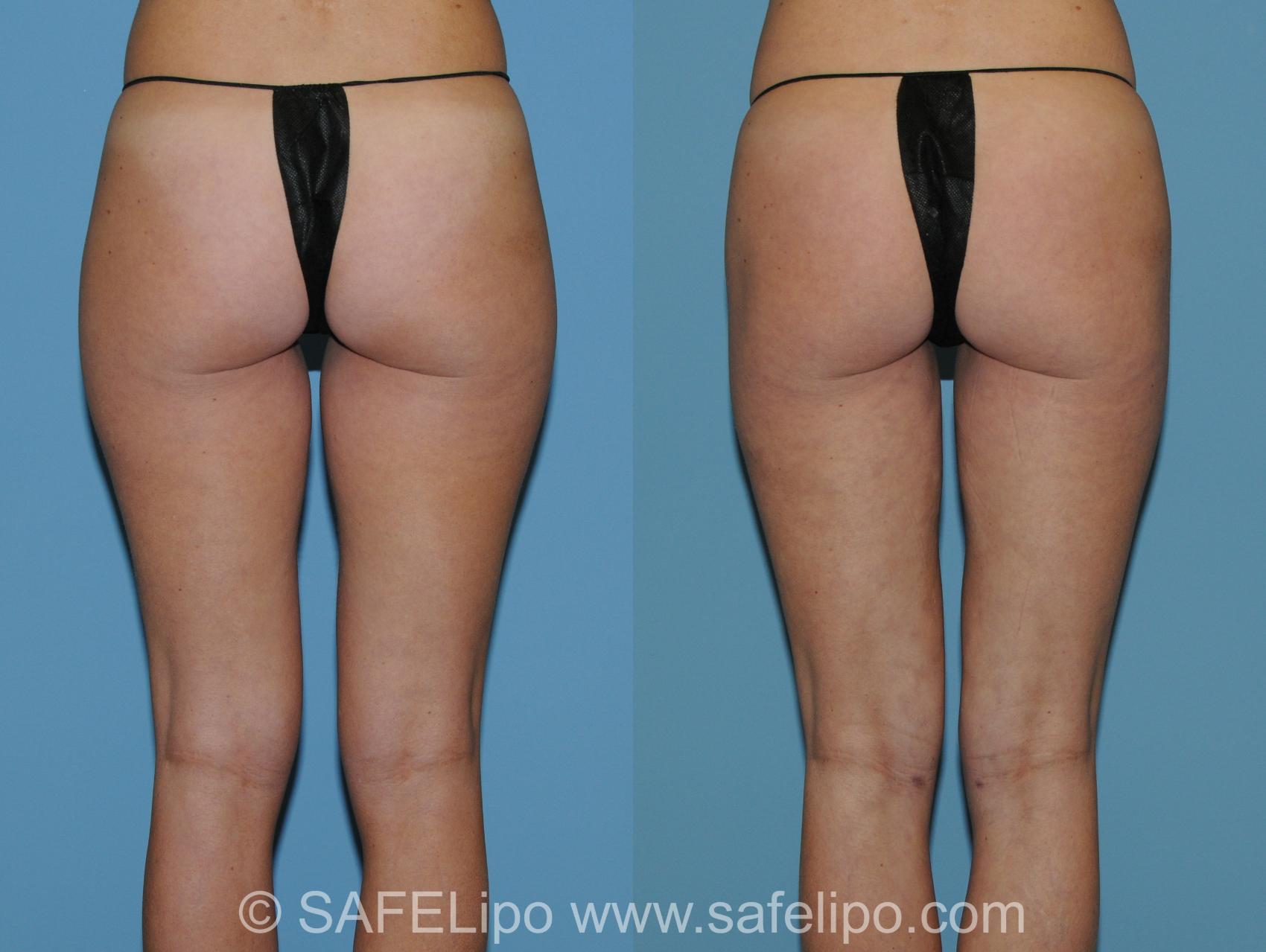 SAFELipo Back Thighs Photo, Shreveport, Louisiana, The Wall Center for Plastic Surgery, Case 271
