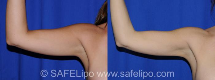 SAFELipo Front Right Photo, Shreveport, Louisiana, The Wall Center for Plastic Surgery, Case 294